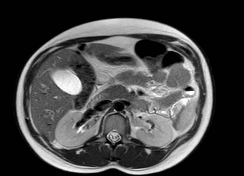 File:Appendicitis in gravida (MRI) (Radiopaedia 89433-106395 Axial T2 22).jpg