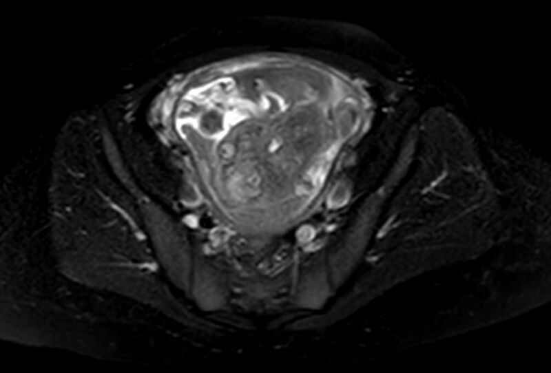 File:Appendicitis in gravida (MRI) (Radiopaedia 89433-106395 Axial T2 SPAIR 61).jpg
