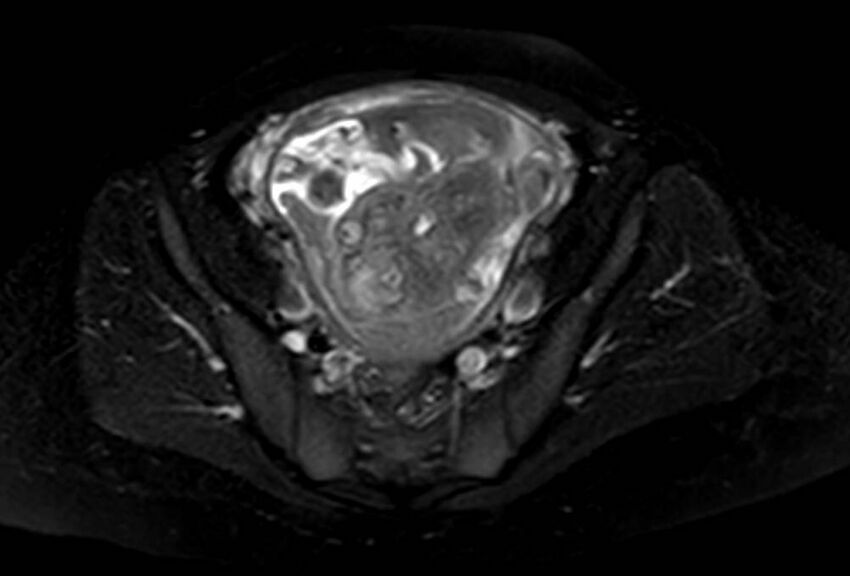Appendicitis in gravida (MRI) (Radiopaedia 89433-106395 Axial T2 SPAIR 61).jpg