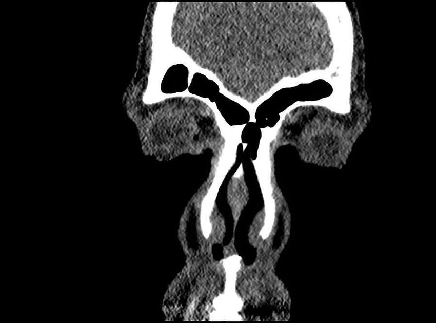 Arachnoid cyst- extremely large (Radiopaedia 68741-78450 Coronal bone window 72).jpg