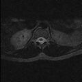 Arachnoid cyst - spinal (Radiopaedia 66835-76157 Axial T2 1).jpg