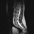 Arachnoid cyst - spinal (Radiopaedia 66835-76157 Sagittal T2 6).jpg