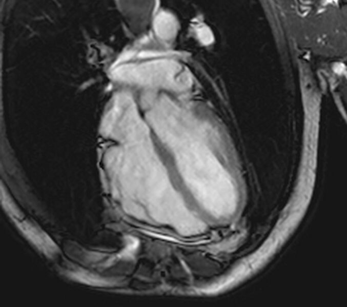 File:Arrhythmogenic right ventricular cardiomyopathy (Radiopaedia 39806-42237 D 2).jpg