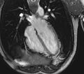 Arrhythmogenic right ventricular cardiomyopathy (Radiopaedia 39806-42237 D 99).jpg