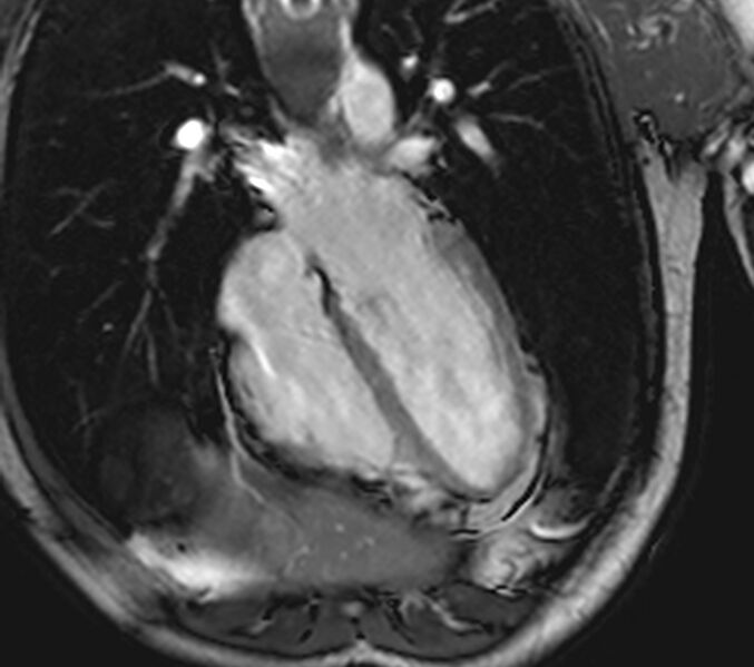 File:Arrhythmogenic right ventricular cardiomyopathy (Radiopaedia 39806-42237 D 99).jpg
