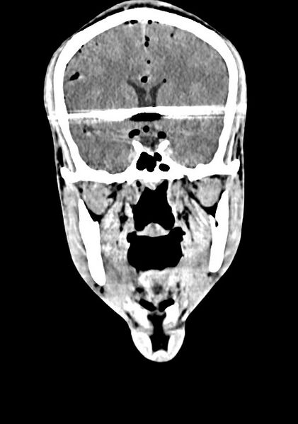 File:Arrow injury to the brain (Radiopaedia 72101-82607 Coronal non-contrast 35).jpg