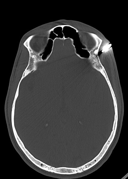 File:Arrow injury to the head (Radiopaedia 75266-86388 Axial bone window 72).jpg