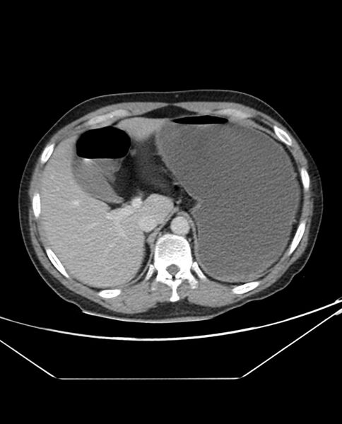 File:Arterial occlusive mesenteric ischemia (Radiopaedia 84641-100054 A 25).jpg