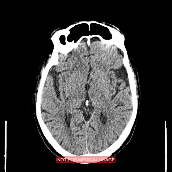 File:Artery of Percheron infarction (Radiopaedia 28679-28967 Axial non-contrast 59).jpg