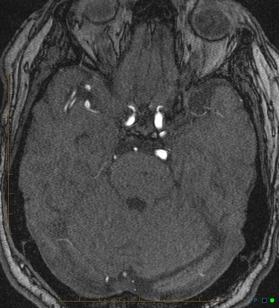 File:Artifactual basilar artery stenosis due to metallic stent (Radiopaedia 31206-31922 Axial MRA 13).jpg
