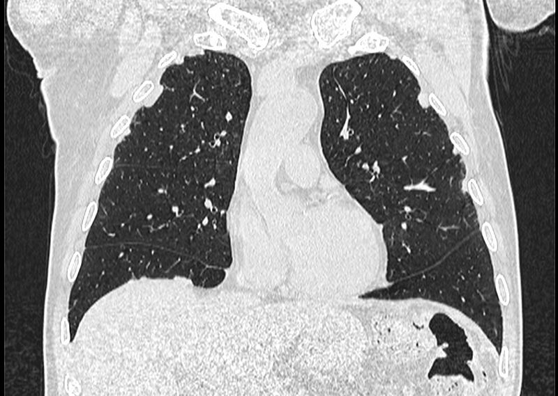 File:Asbestos pleural placques (Radiopaedia 57905-64872 Coronal lung window 107).jpg