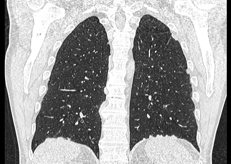 File:Asbestos pleural placques (Radiopaedia 57905-64872 Coronal lung window 218).jpg