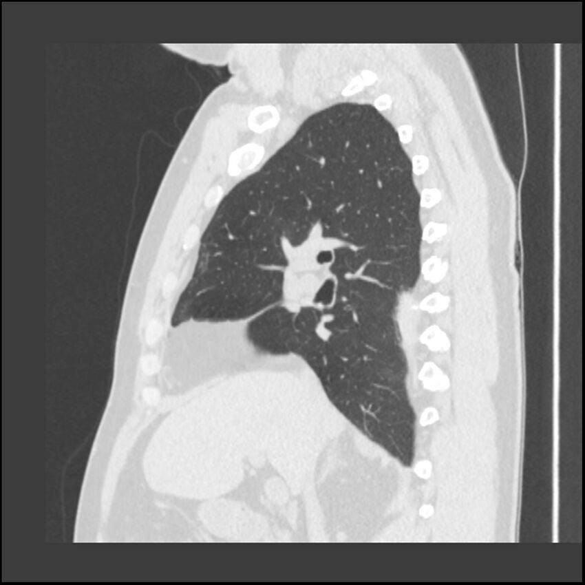 Asbestosis (Radiopaedia 45002-48961 Sagittal lung window 83).jpg