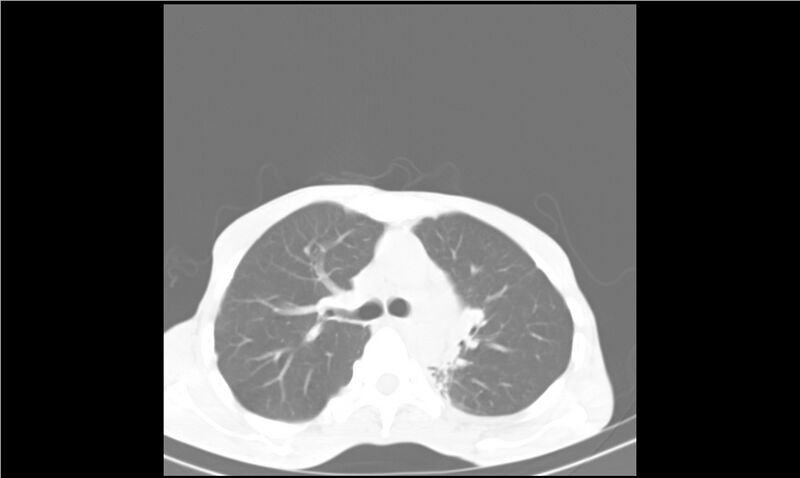 File:Aspergilloma (Radiopaedia 20788-20701 Axial lung window 13).jpg
