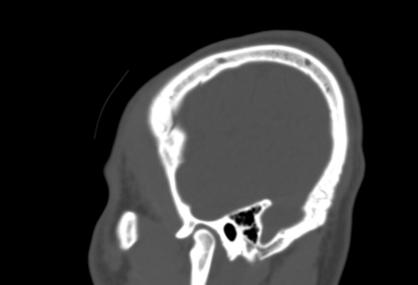 Asymptomatic occipital spur (Radiopaedia 87753-104201 Sagittal bone window 276).jpg