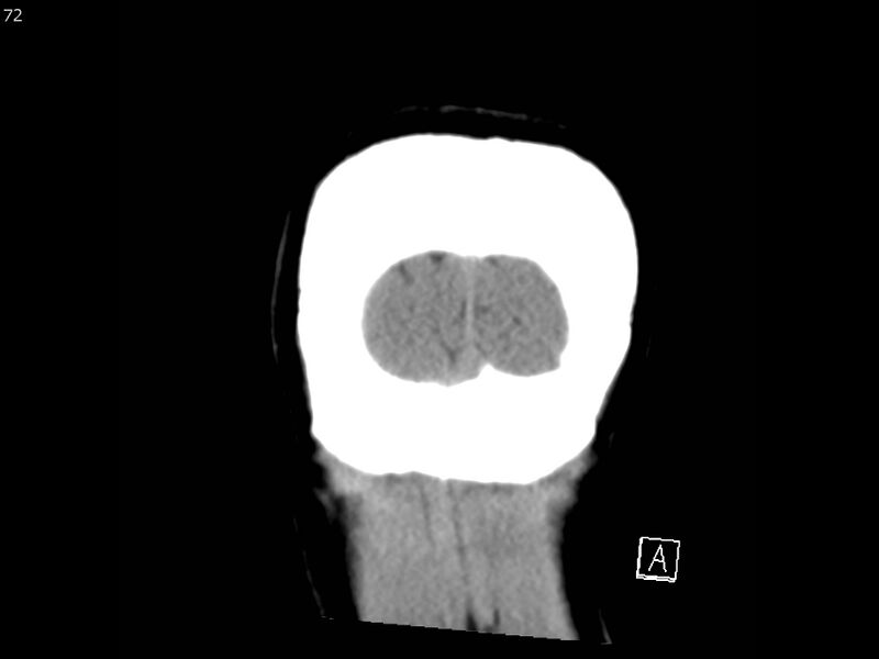 File:Atypical meningioma - intraosseous (Radiopaedia 64915-73867 B 71).jpg