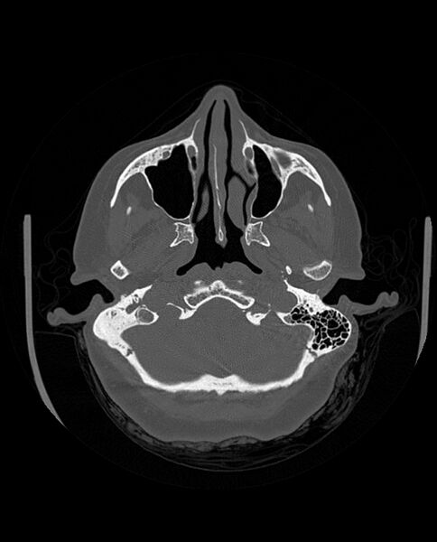 File:Automastoidectomy with labyrinthine fistula (Radiopaedia 84143-99411 Axial non-contrast 66).jpg
