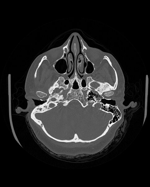 File:Automastoidectomy with labyrinthine fistula (Radiopaedia 84143-99411 Axial non-contrast 76).jpg