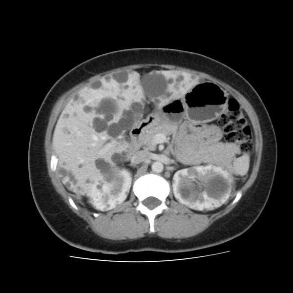 File:Autosomal dominant polycystic kidney disease (Radiopaedia 23061-23093 C 22).jpg