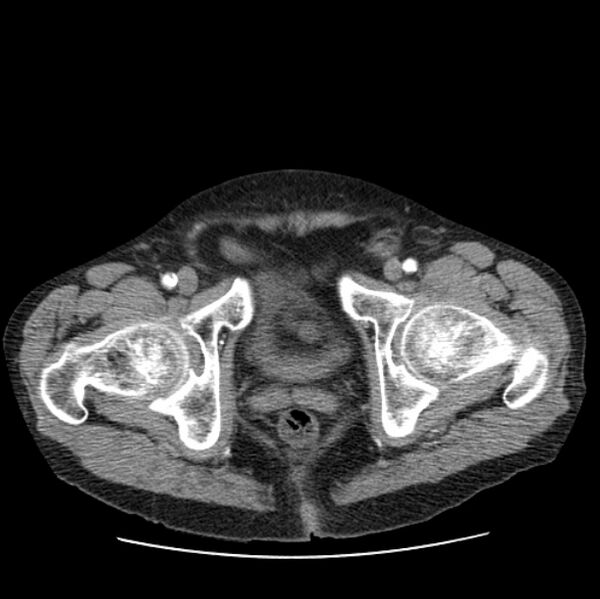 File:Autosomal dominant polycystic kidney disease (Radiopaedia 27851-28094 B 118).jpg
