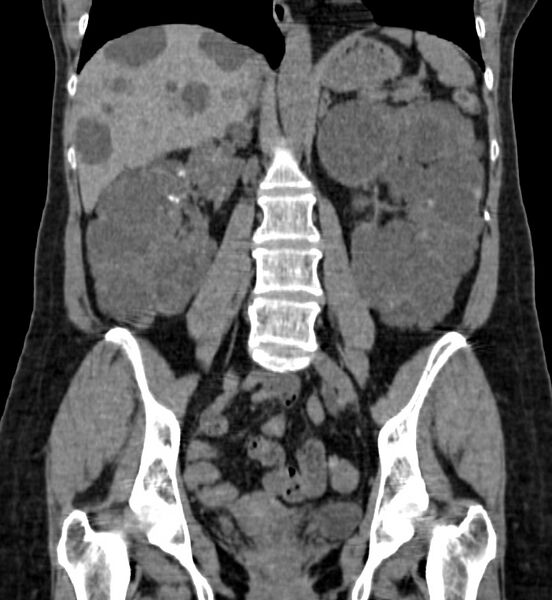 File:Autosomal dominant polycystic kidney disease (Radiopaedia 41918-44922 Coronal non-contrast 27).jpg