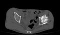 Avascular necrosis of the left hip (Radiopaedia 75068-86125 Axial bone window 21).jpg