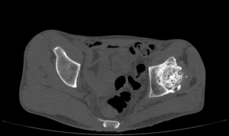 File:Avascular necrosis of the left hip (Radiopaedia 75068-86125 Axial bone window 21).jpg