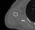 Avulsion fracture - greater tuberosity of humerus (Radiopaedia 71216-81514 Axial bone window 60).jpg