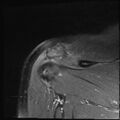 Avulsion fracture - greater tuberosity of humerus (Radiopaedia 71216-81515 Coronal PD fat sat 6).jpg