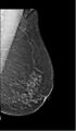 BIRADS V lesion (Radiopaedia 89220-106096 D 1).jpg