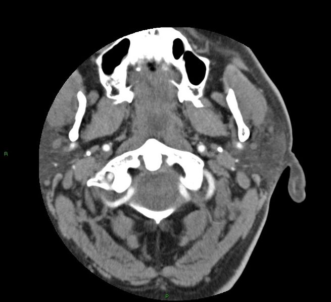 File:Basal ganglia hemorrhage (Radiopaedia 58763-65985 D 4).jpg