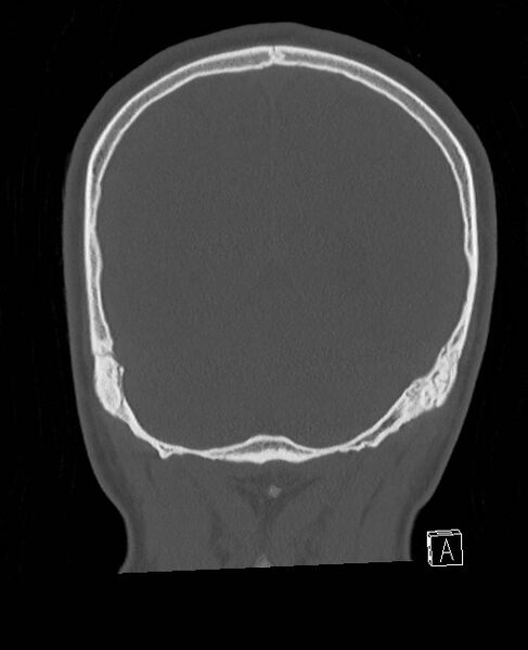 File:Base of skull fracture with bilateral Le Fort fractures (Radiopaedia 47094-51638 Coronal bone window 23).jpg