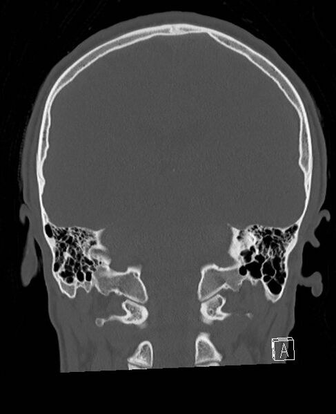 File:Base of skull fracture with bilateral Le Fort fractures (Radiopaedia 47094-51638 Coronal bone window 37).jpg