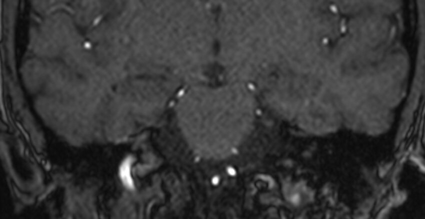 Basilar artery fenestration (Radiopaedia 74537-85455 Coronal MRA TOF 54).jpg