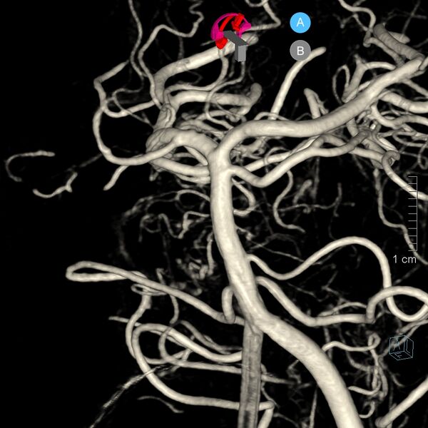 File:Basilar artery perforator aneurysm (Radiopaedia 82455-97734 3D view left VA 35).jpg
