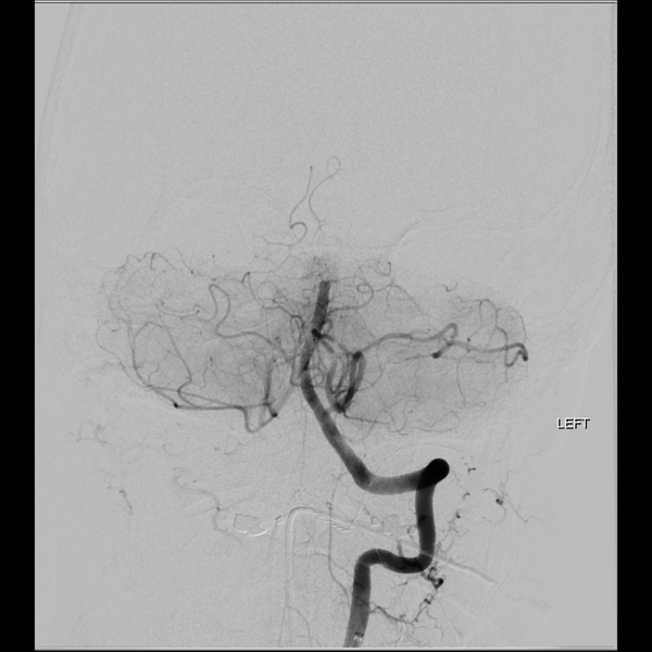 File:Basilar tip thrombus with endovascular clot retrieval (Radiopaedia 46320-50726 B 11).png