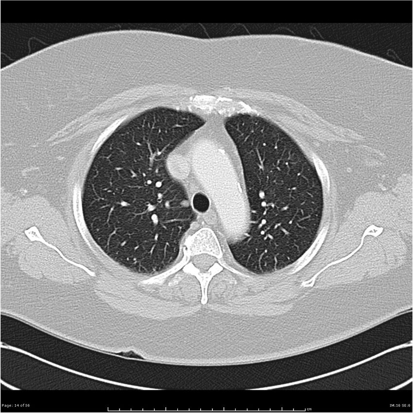 Benign metastasizing leiomyoma (Radiopaedia 26803-26962 Axial lung window 14).jpg