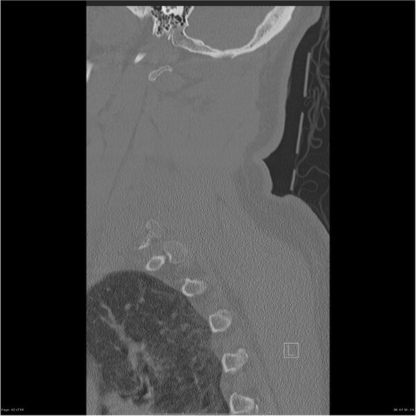 File:Bilateral cervical ribs (Radiopaedia 25868-26017 Sagittal bone window 62).jpg