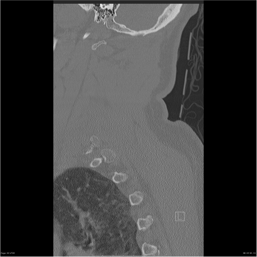 Bilateral cervical ribs (Radiopaedia 25868-26017 Sagittal bone window 62).jpg