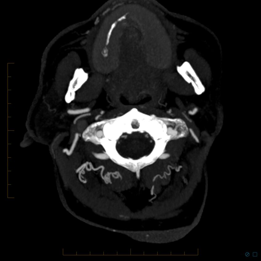Bilateral chronic common carotid occlusion (Radiopaedia 50849-56362 D 31).jpg