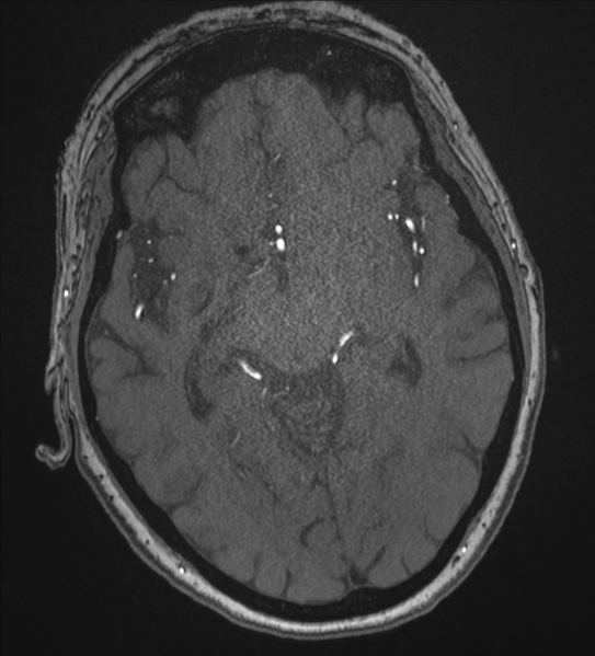 File:Bilateral fetal posterior communicating arteries (Radiopaedia 41286-44102 Axial MRA 95).png