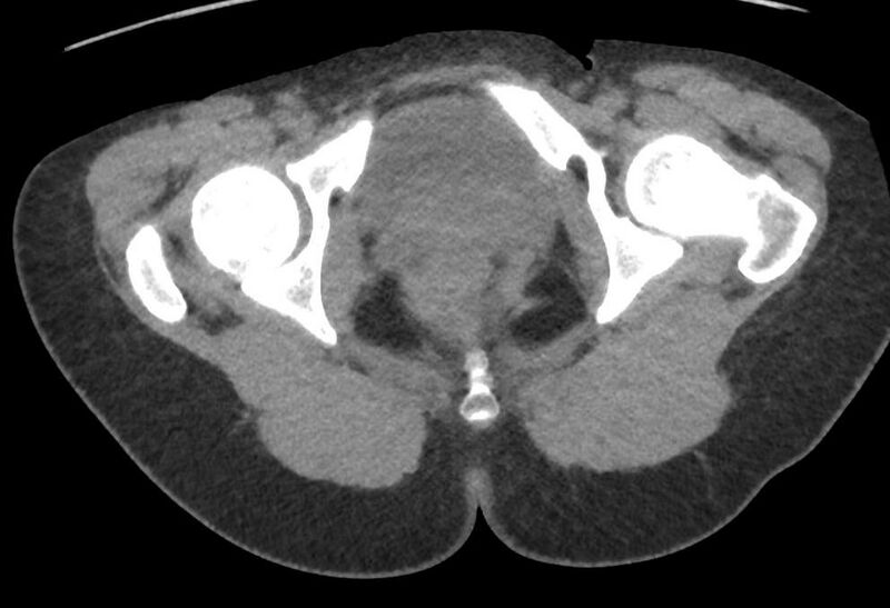 File:Bilateral mature cystic ovarian teratoma (Radiopaedia 88821-105592 Axial non-contrast 55).jpg