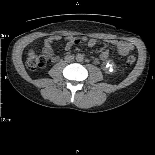 File:Bilateral medullary nephrocalcinosis with ureteric calculi (Radiopaedia 71269-81569 Axial non-contrast 67).jpg
