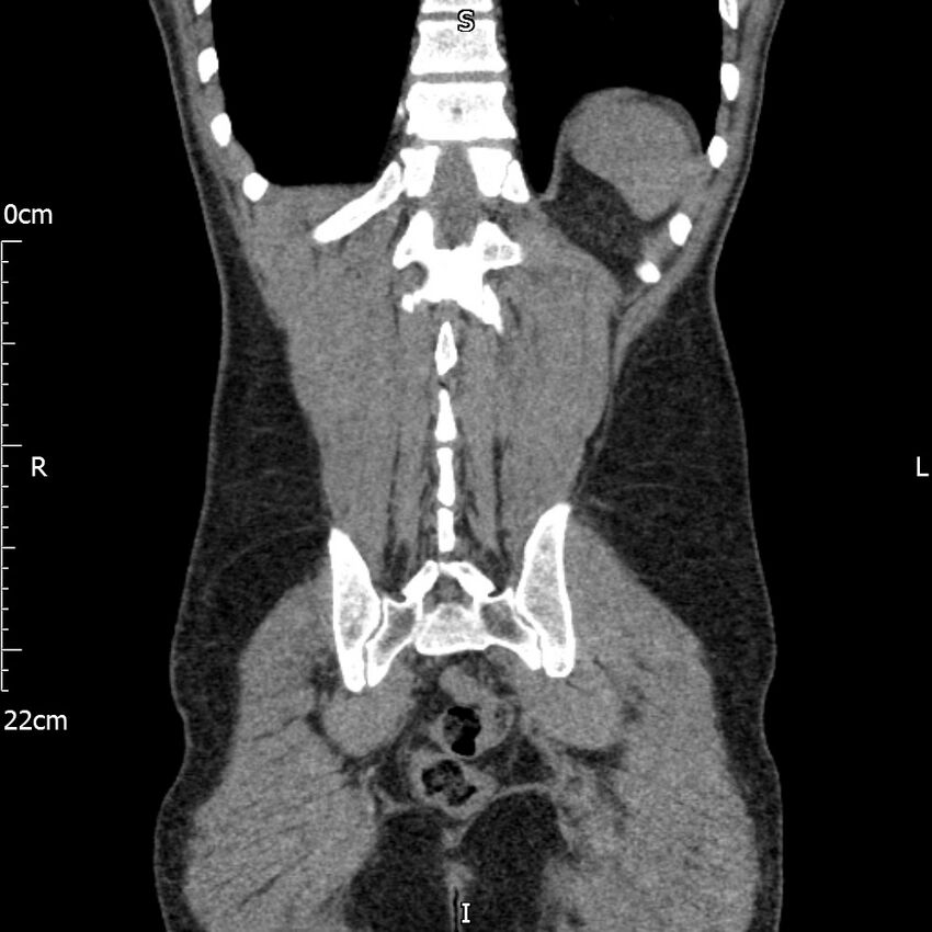 Bilateral medullary nephrocalcinosis with ureteric calculi (Radiopaedia 71269-81569 Coronal non-contrast 60).jpg