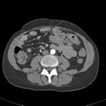 Biliary necrosis - liver transplant (Radiopaedia 21876-21845 A 37).jpg