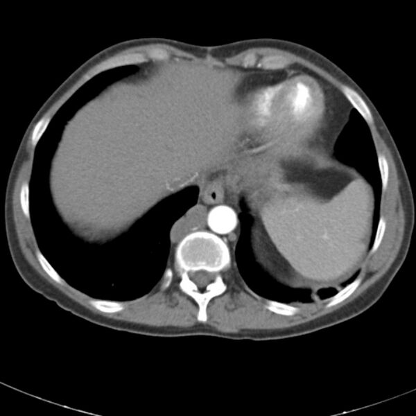 File:Biliary necrosis - liver transplant (Radiopaedia 21876-21845 A 7).jpg