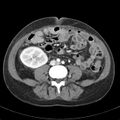 Biliary necrosis - liver transplant (Radiopaedia 21876-21846 B 47).jpg