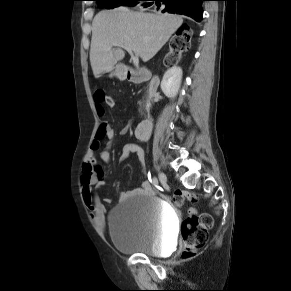 File:Bladder tumor detected on trauma CT (Radiopaedia 51809-57609 E 45).jpg