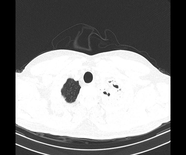 File:Bochdalek hernia - adult presentation (Radiopaedia 74897-85925 Axial lung window 3).jpg