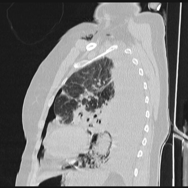 File:Boerhaave syndrome (Radiopaedia 45644-49799 Sagittal lung window 60).jpg